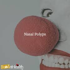 Nasal polyps treatment miracle review: The Science Behind Nasal Polyps 12 Most Effective Home Remedies Food N Health