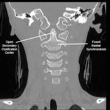 Atlantoaxial Rotatory Displacement Aard Spine Orthobullets