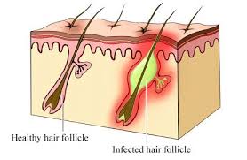 4 Ways To Prevent Ingrown Hairs Depil Brazil Waxing Studio A Better Wax A Smoother You Infected Ingrown Hair Ingrown Hair Prevent Ingrown Hairs