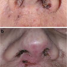 Other signs and symptoms may include fever, headaches, a poor. Pdf Nasal Vestibulitis Due To Targeted Therapies In Cancer Patients