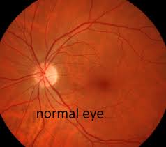 This is serious and can lead to permanent vision loss if not treated. Spots And Flashes Eye Doctor In Elmhurst Il