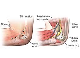 Aceasta este o procedura minim invaziva ce nu afecteaza structurile anatomice ale zonei gatului si nu provoaca instabilitate, permitand in acelasi timp pacientului sa se. Preturi Operatii Dr Dan Martin