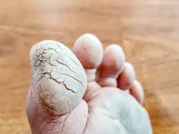 L'ampoule (appelée aussi cloque ou bulle) se caractérise par un détachement d'une partie de la peau qui se remplit ensuite d'un liquide transparent friction répétée et échauffement sur une partie de la peau. Crevasses Au Pied Cause Symptome Et Traitement Piedreseau