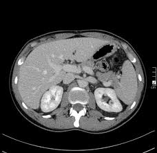 Nutcracker Syndrome Radiology Case Radiopaedia Org