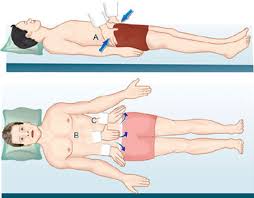 Image result for Pelvic Compression Test