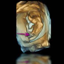 In dieser frühen zeit kann in ein paar tagen sehr viel schwangerschaftswoche. 3d 4d Ultraschall Fotogalerie
