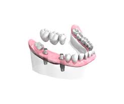 Dentiste24.fr vous propose la liste des dentistes aigrefeuillais. Pose D Un Bridge Ceramique Sur Implants Docteur Mickael Lehmann