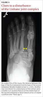 Avulsion fractures can be confused with other types of fractures to the fifth metatarsal bone. Painful Foot Or Ankle Don T Overlook These 5 Injuries Mdedge Family Medicine