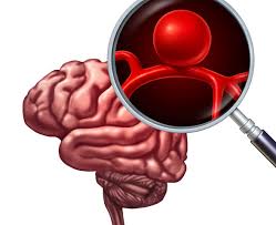 Emorragia cerebrale, quali sono le cause e le caratteristiche sintomatologiche di questa condizione patologica, come riconoscerla e curarla. Emorragia Cerebrale Come Intervenire Fondazione Umberto Veronesi