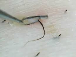 Ingrown hairs cause red, often itchy bumps where a hair has grown back into the skin. Ingrown Hair China Pdf Ppt Case Reports Symptoms Treatment