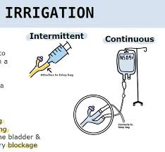 Image result for Bladder Irrigation