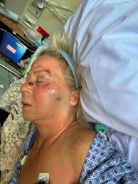 Fundraiser for Mike Brown by Cheryl Pullich : Catherine Judy Belch Brown  needs a leg