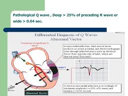 >2mv / small squares deep; Electrocardiogram Ecg Ppt Download