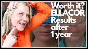 Dr. Phillip Yoo shares his experience using the LightStim LED Bed (Part 3  of 3)