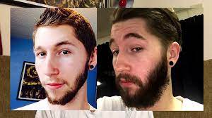 Apply minoxidil topically to the area of hair. Minoxidil Beard Month 7 The Experiment Video Dailymotion
