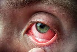 Image result for Allergic Conjunctivitis
