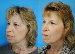Rhinoplasty In 2020 Rhinoplasty Nose Surgery Human