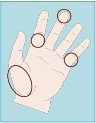 Image result for Capillary Puncture