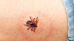 Borelioza (choroba z lyme) jest najczęściej występującą chorobą zakaźną na świecie przenoszoną przez kleszcze. Objawy Boreliozy Wczesne I Pozne Symptomy I Rumien Wedrujacy Choroby Polki Pl
