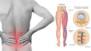 8 sciatica stretches that prevent and