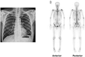 bone metastasis can be painful and can cause other problems, such as fractures (breaks), spinal cord compression (an area of cancer is pressing on the spinal cord), or high blood calcium levels, which can be dangerous or even life threatening. Metastatic Prostate Cancer Initially Presenting As Chylothorax A Case Report