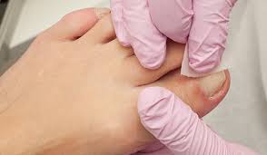 Image result for Toenail Removal