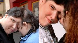 Identical twins Jim Lewis and Jim Springer were separated at birth but went 