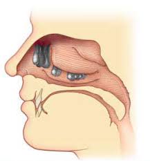 In general, medications such as. Nasal Polyp India Nasal Polyp Removal Surgery Cost Nasal Polyp Surgery