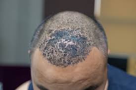 بعد عملية زراعة الشعر النصائح وما يمكن أن تواجهه