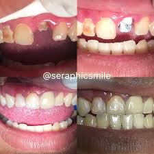 Gigi palsu crown adalah jenis gigi palsu permanen yang di buat untuk menggantikan mahkota gigi yang rusak, patah, berlubang, atau mengalami kerusakan yang parahyang sudah tidak bisa di tambal lagi, gigi crown di buat mirip dengan mahkota gigi asli. Jual Gigi Palsu Permanent Metal Porcelain Jacket Crown Pelindung Gigi Rusak Di Lapak Denis Rezky Bukalapak