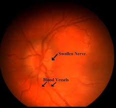 Learn about idiopathic intracranial hypertension (iih) symptoms and diagnosis. Intracranial Hypertension Pseudotumor Cerebri Diagnosis Treatment