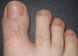 early sign of toenail fungus لم يسبق له