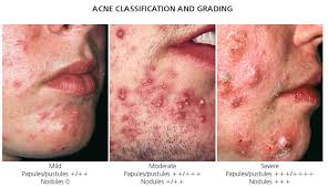 Check spelling or type a new query. Dermatology 3 Acneiform Diseases Lim Flashcards Memorang