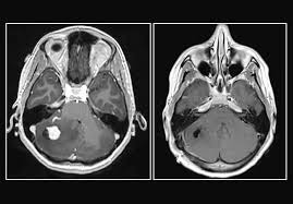 Image result for Brain Lesion