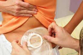 Biggest Innovations Of Global Stoma Care Ostomy Care And