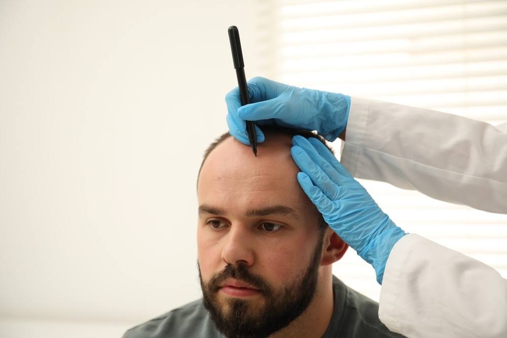 Hair Transplant | Hair Loss product image