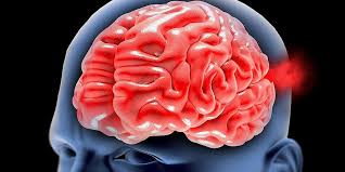 Un aneurisma cerebral es una protuberancia o dilatación en un vaso sanguíneo en el cerebro. Aneurisma Cerebral