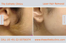 The following areas of laser hair removal are $45 each: Laser Hair Removal Mumbai Permanent Hair Removal Treatment Cost India The Esthetic Clinics