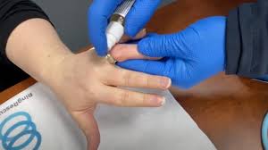 Image result for Ring Removal