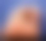 Image result for syphilis ulcer