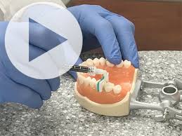 As the bacterial plaque in your mouth produces acid after eating your dietary sugar, that acid slowly eats away at your. New Cavity Treatment Offers No Drilling No Filling News Uab