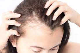 Istilah medis untuk penyakit yang disebabkan oleh kutu seseorang dapat terkena kutu rambut akibat kontak dengan kepala orang lain yang memiliki kutu rambut. Rambut Gugur Pelbagai Faktor Yang Memungkinkannya Terjadi