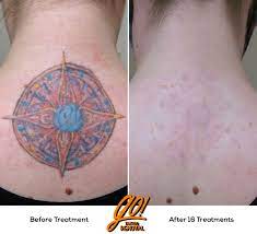 What 95 Gone Looks Like For A Saturated And Tricky Tattoo Removal More In The Comments Tattooremoval