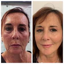 Deep plane facelift and lower eyelid lift, 1 year postop results. Many  patients ask if I also do cosmetic surgery. Aesthetics is a part of every  plastic surgeons training. Our goal for