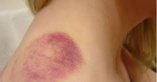How To Get Rid Of Bruises Overnight Bruises Remedy Home Remedies For Bruises Bruises