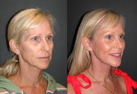 understatedekegance !!! Today I was so excited to see this 56 year old  patient of mine 3 months after her #deepplanefacelift and I live the way  she looks!! I balanced her face