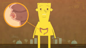 The digestive system animation library contains over 25 3d medical animations that embed into your website. Animation Who S At Risk For Colon Cancer Ed Ted Com Goodjobstudios