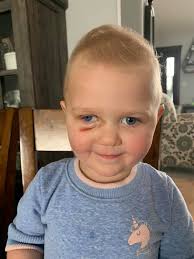 Marfan Syndrome and Prosthetic Eye Experience