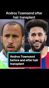 Andros Townsend Hair Transformation: Before and After Hair Transplant