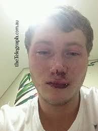 More agony as teen fights for life